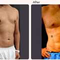 Six Pack Abs Surgery In Delhi - Dr Rajat Gupta