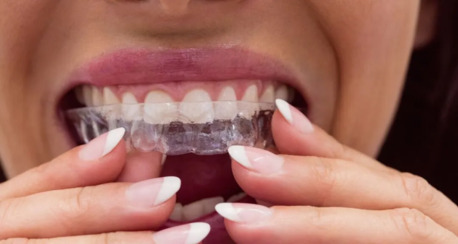 Perth, Dental, Checkout The Ultimate Guide To Nightguards From Nearby Dental Clinic In Ormeau City