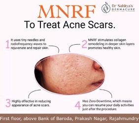 Kurnool, Health, Benefits Of MNRF Treatment For Scars