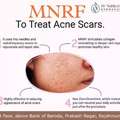 Benefits Of MNRF Treatment For Scars