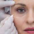 Rejuvenate Your Eyes With Expert Blepharoplasty Treatment In Delhi