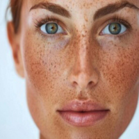New York, Beautician, Sunspots Treatment Fort Collins Brighten And Even Skin Tone