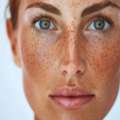 Sunspots Treatment Fort Collins Brighten And Even Skin Tone
