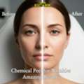 TCA Peel In Michigan &ndash; Before & After Skin Transformation