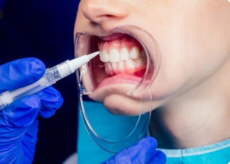 New York, Dental, Bone Grafting In Beverly Hills For Stronger Oral Health