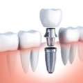 San Diego Teeth Whitening