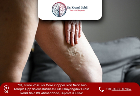 Ahmedabad, Health, Improve Leg Health With Advanced Vein Care