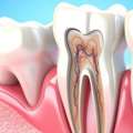 Best Root Canal Treatment In Delhi NCR