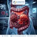 Dr. Dhaval Patel &ndash; Trusted Specialist For GI Cancer Treatment