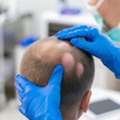 Trusted Alopecia Specialist For Hair Loss GA | Hair Clinique Restoration Center