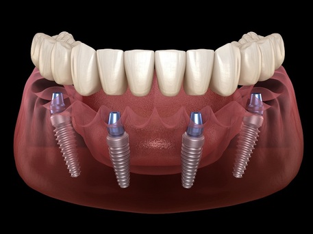 Mexico City, Dental, All-on-4 Dental Implants In Tijuana, Mexico &ndash; Affordable, Life-Changing Results!