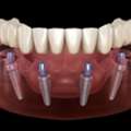 All-on-4 Dental Implants In Tijuana, Mexico &ndash; Affordable, Life-Changing Results!