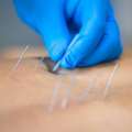 Dry Needling For Active Lifestyle Recovery Care In Singapore