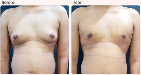 New Delhi, Health, Gynecomastia Surgery Cost In Delhi - Dr Rajat Gupta