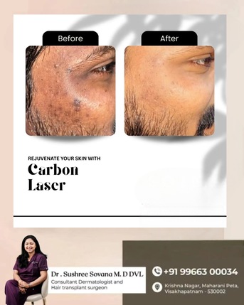 Visakhapatnam, Health, Laser Carbon Facial Game Changer For Your Skin- Derma One Clinic - Visakhpatnam