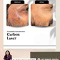 Laser Carbon Facial Game Changer For Your Skin- Derma One Clinic - Visakhpatnam