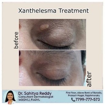 Kurnool, Health, Xanthelasma And Treatment In Rajahmundry