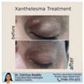 Xanthelasma And Treatment In Rajahmundry