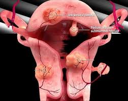 Punjab, Health, Uterine Fibroid Embolization For Safe & Effective Fibroid Care