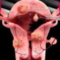 Uterine Fibroid Embolization For Safe & Effective Fibroid Care