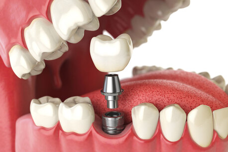 Jaipur, Dental, Best Dental Implant In Jaipur For Tooth Replacement