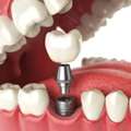 Best Dental Implant In Jaipur For Tooth Replacement