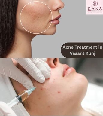 New Delhi, Health, Effective Solutions For Acne Scars At Kara Skin Clinic In Vasant Kunj