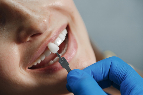 Dubai, Dental, Cost-Effective Dental Veneers In Dubai &ndash; Loldent Dental Clinic