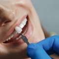 Cost-Effective Dental Veneers In Dubai &ndash; Loldent Dental Clinic