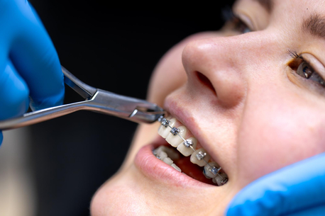 Dubai, Dental, Straighten Your Smile With Braces In Dubai &ndash; Loldent Dental Clinic