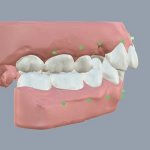 Chennai, Dental, Invisible Aligners Treatment For Proclined Teeth, Tamilnadu