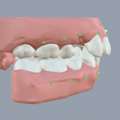 Invisible Aligners Treatment For Proclined Teeth, Tamilnadu