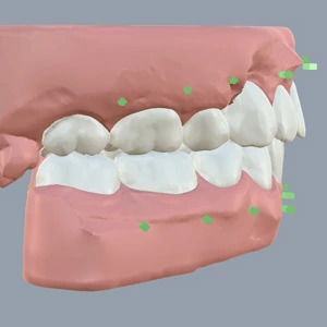 Chennai, Dental, Invisible Aligners Treatment For Proclined Teeth, Tamilnadu