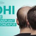 Natural-Looking Hair Restoration With DHI Technique In Kondapur