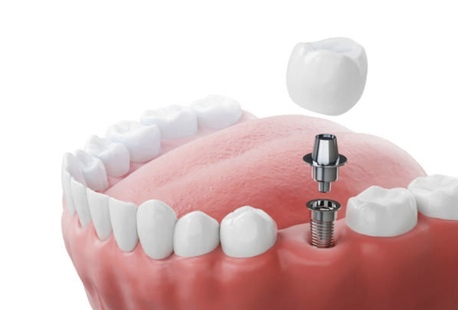 Auckland, Health, Dental Implants In Mount Roskill, Auckland