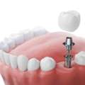 Dental Implants In Mount Roskill, Auckland