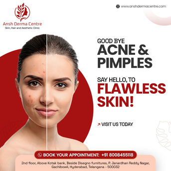 Hyderabad, Health, Acne Treatment In Gachibowli