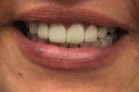 New York, Dental, Damaged Teeth With Porcelain Crowns In Chandler