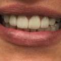 Damaged Teeth With Porcelain Crowns In Chandler
