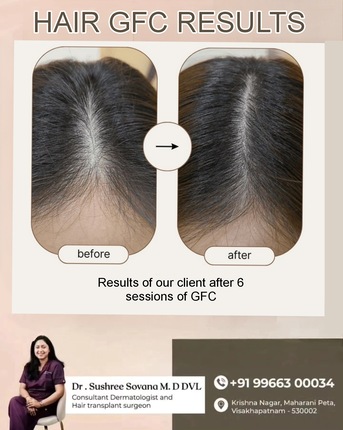 Visakhapatnam, Health, Benefits Of Hair GFC Treatment - Derma One Clinic
