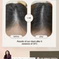 Benefits Of Hair GFC Treatment - Derma One Clinic