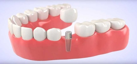 Kabul, Dental, Best Dental Clinic In Coimbatore With Top Dental Treatments