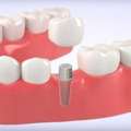 Best Dental Clinic In Coimbatore With Top Dental Treatments