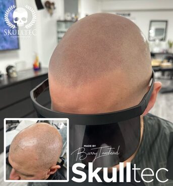 London, Beautician, Premium Hair Pigmentation Services In London - SkullTec