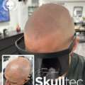 Premium Hair Pigmentation Services In London - SkullTec