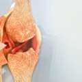 Bone Cancer Hospital In Delhi