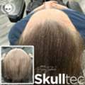Effective Hair Loss Solutions For Men In Scotland - SkullTec
