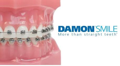 Jumeirah, Health, Advanced Damon Braces Treatment Services In Jumeirah, Dubai
