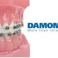 Advanced Damon Braces Treatment Services In Jumeirah, Dubai