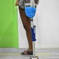 Best Artificial Limb Fitting Center In Hyderabad